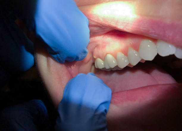 Best Emergency Dentist for Lost Fillings or Crowns in Royse City, TX